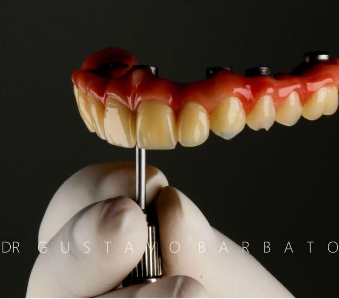 O que é um implante dentário?