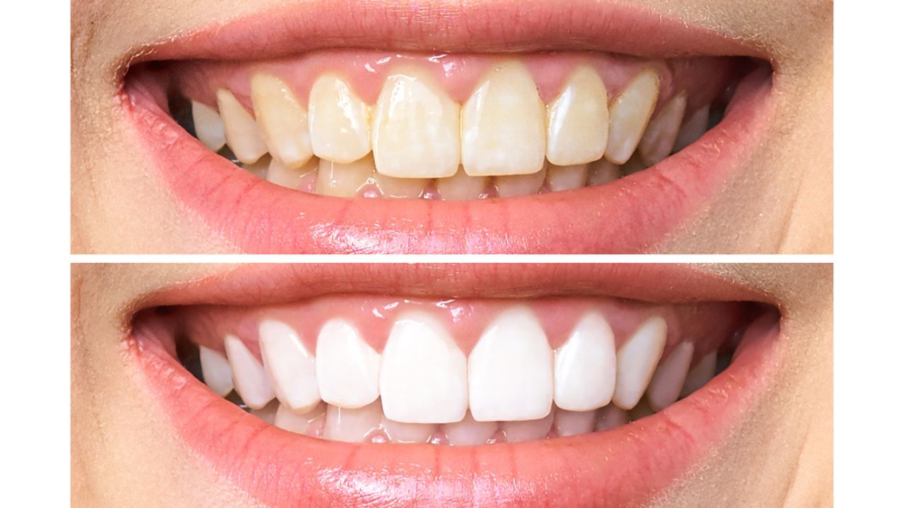 Saiba como funciona o clareamento dental