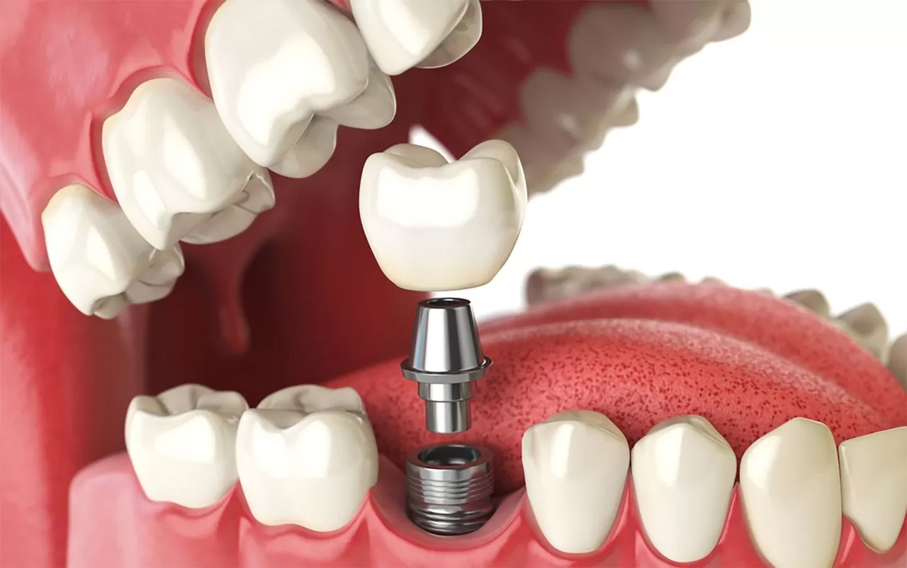 Tipos de implantes dentários