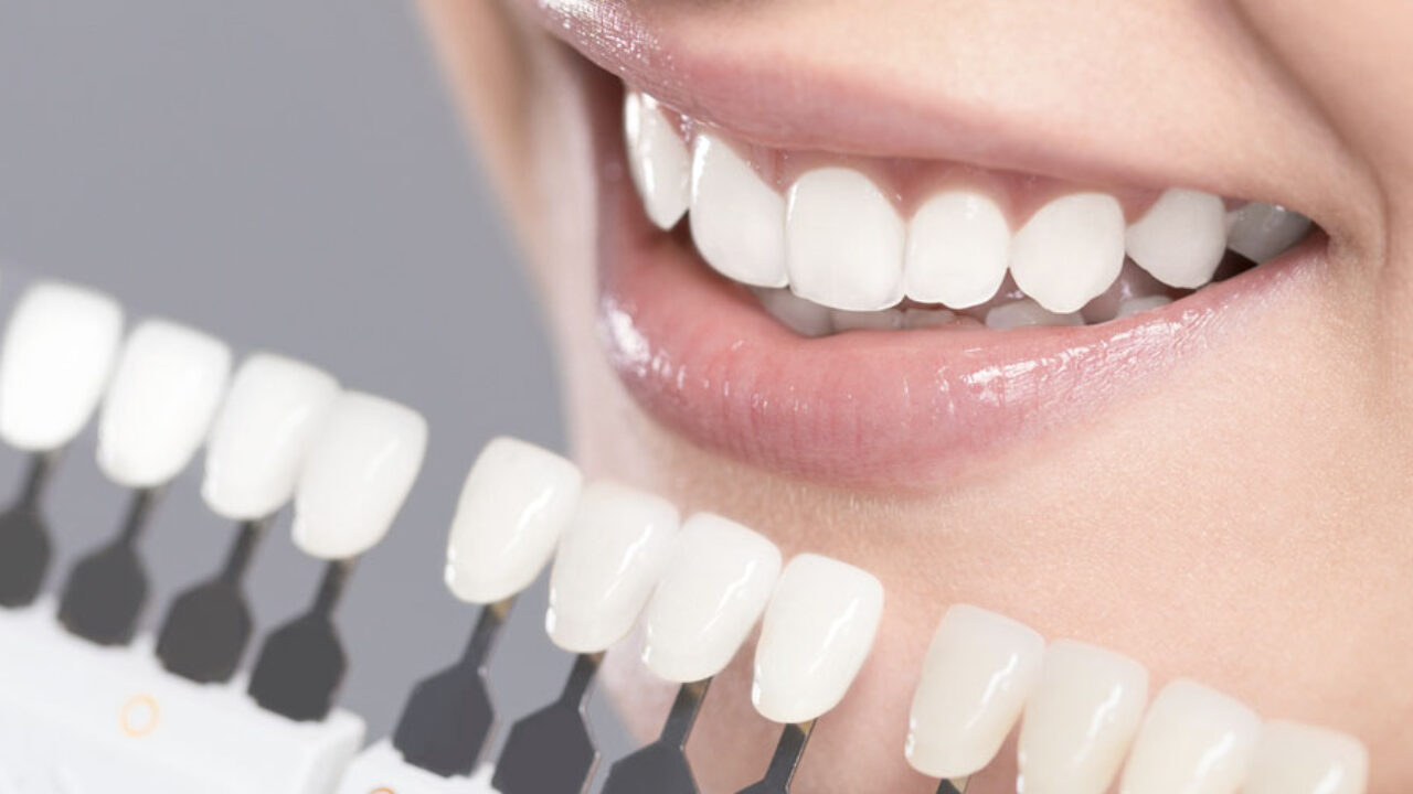 Facetas dentárias: Como escolher o modelo mais indicado?